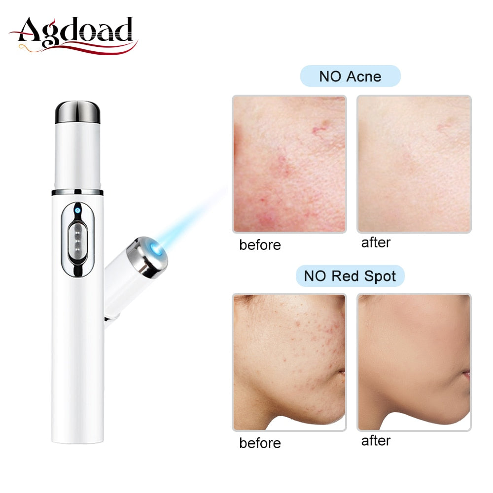 Acne Laser Pen Portable Wrinkle Removal Machine Soft Scar Removal Blue Light Therapy Pen Face Skin Care Tool Acne Remover